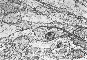 F,75y. | meningotheliomatous meningeoma